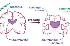 Врач дала совет по профилактике деменции