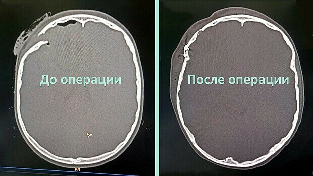 Врачи спасли зрение мальчику, пострадавшему в ДТП